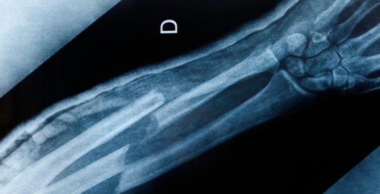 Broken Bone
